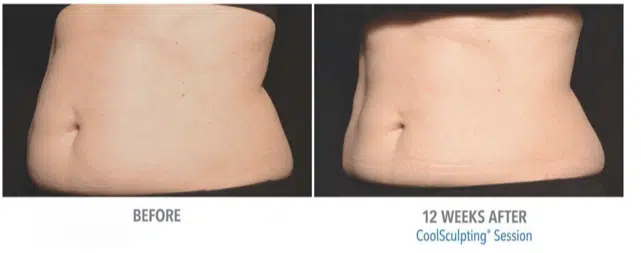 Does CoolSculpting Work?