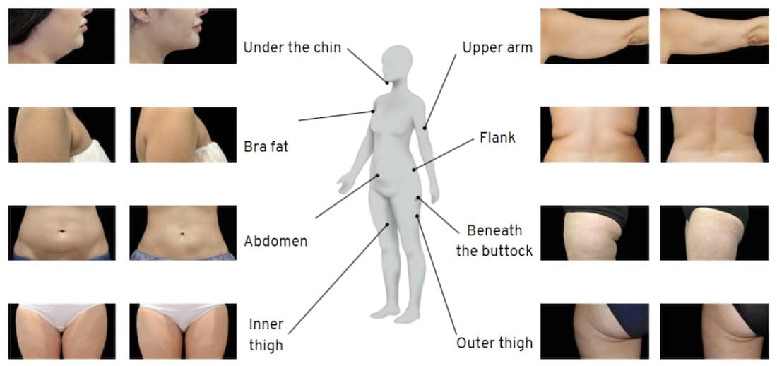 CoolSculpting Treatment Areas