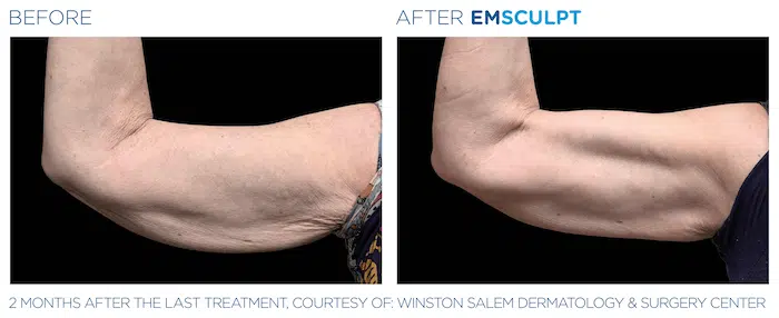 EMSculpt Arms Before and After