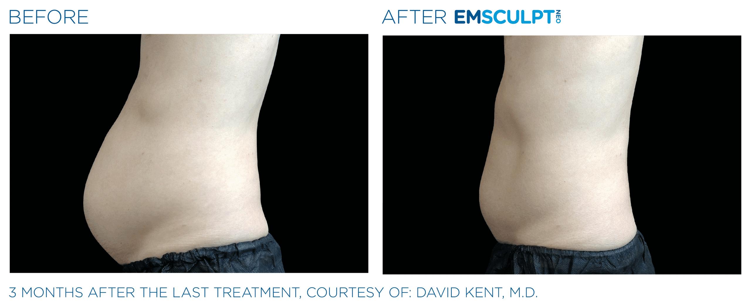 EMSCULPT NEO helps get rid of belly fat