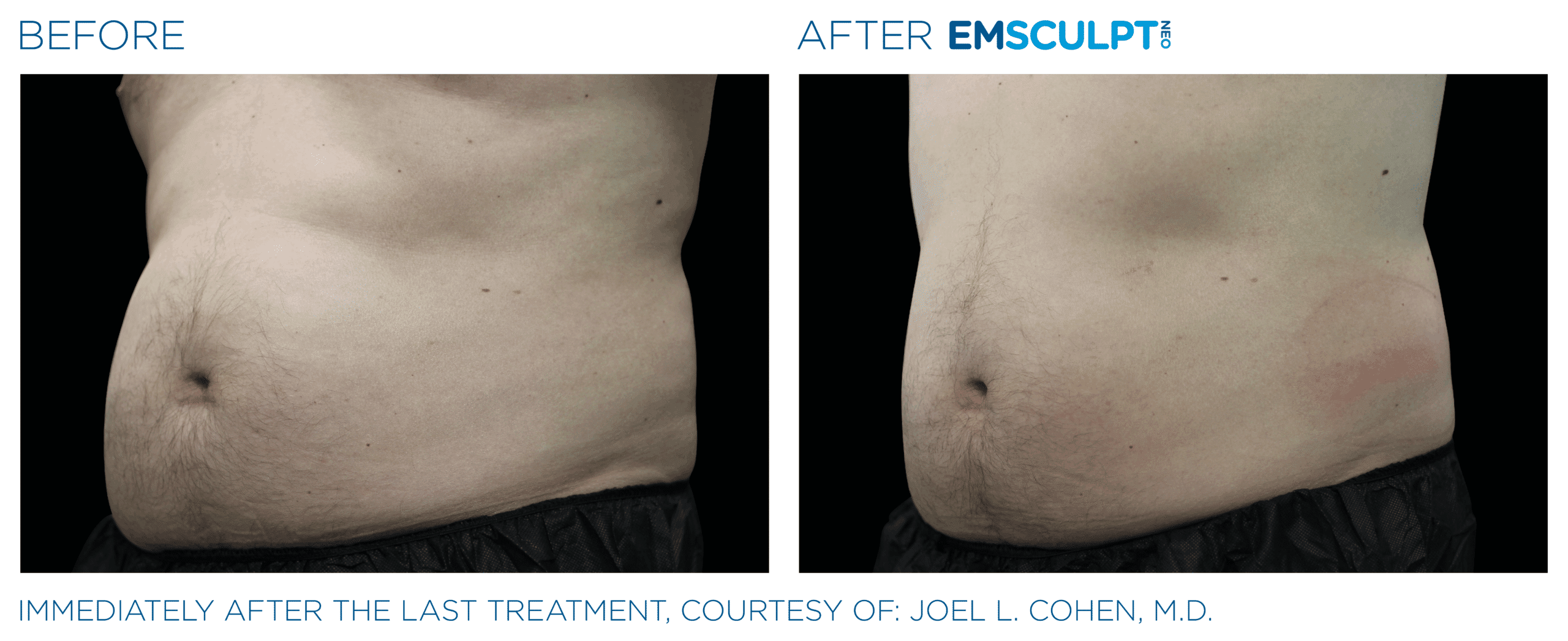 EMSCULPT NEO builds muscle, burns fat, and helps weight loss