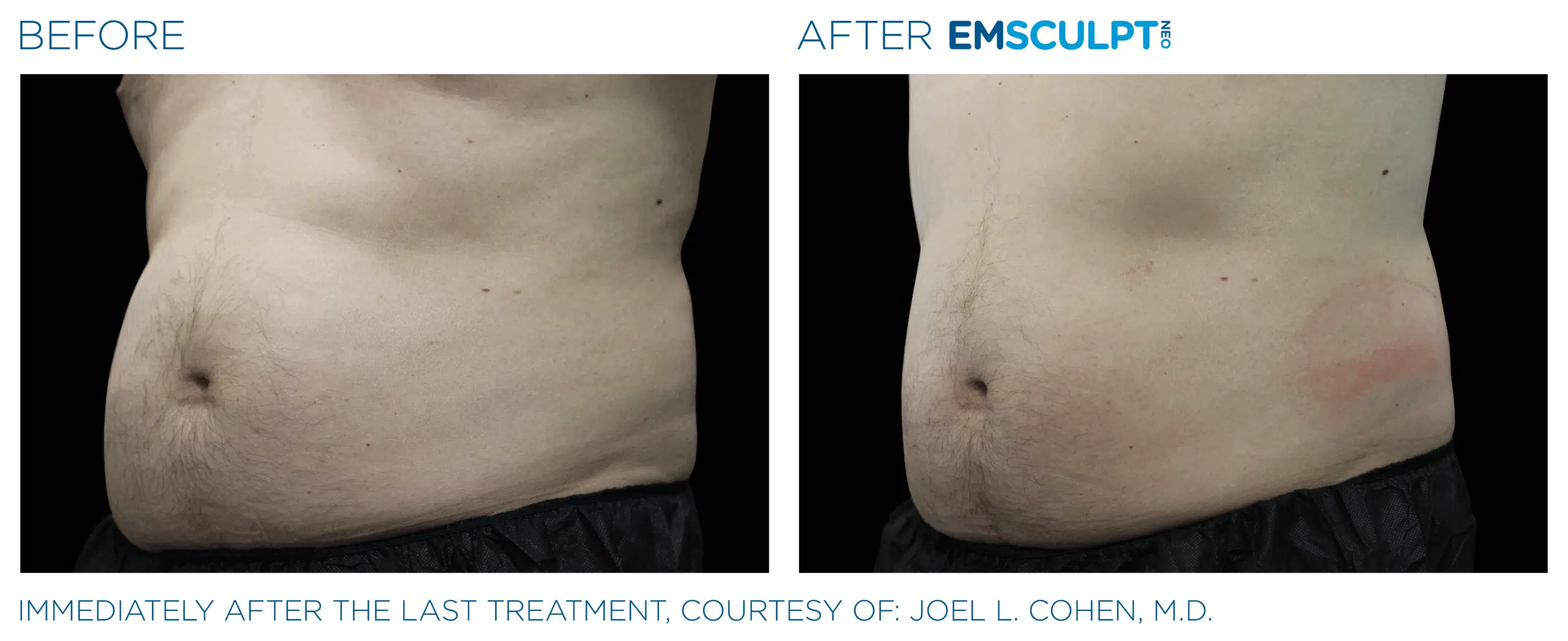 EMSCULPT NEO builds muscle, burns fat, and helps weight loss