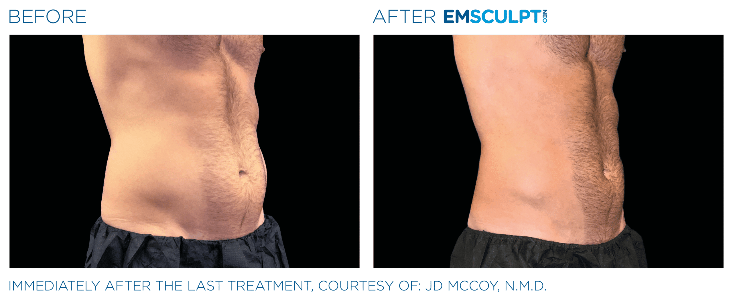 EMSCULPT NEO builds muscle, burns fat, and tightens skin