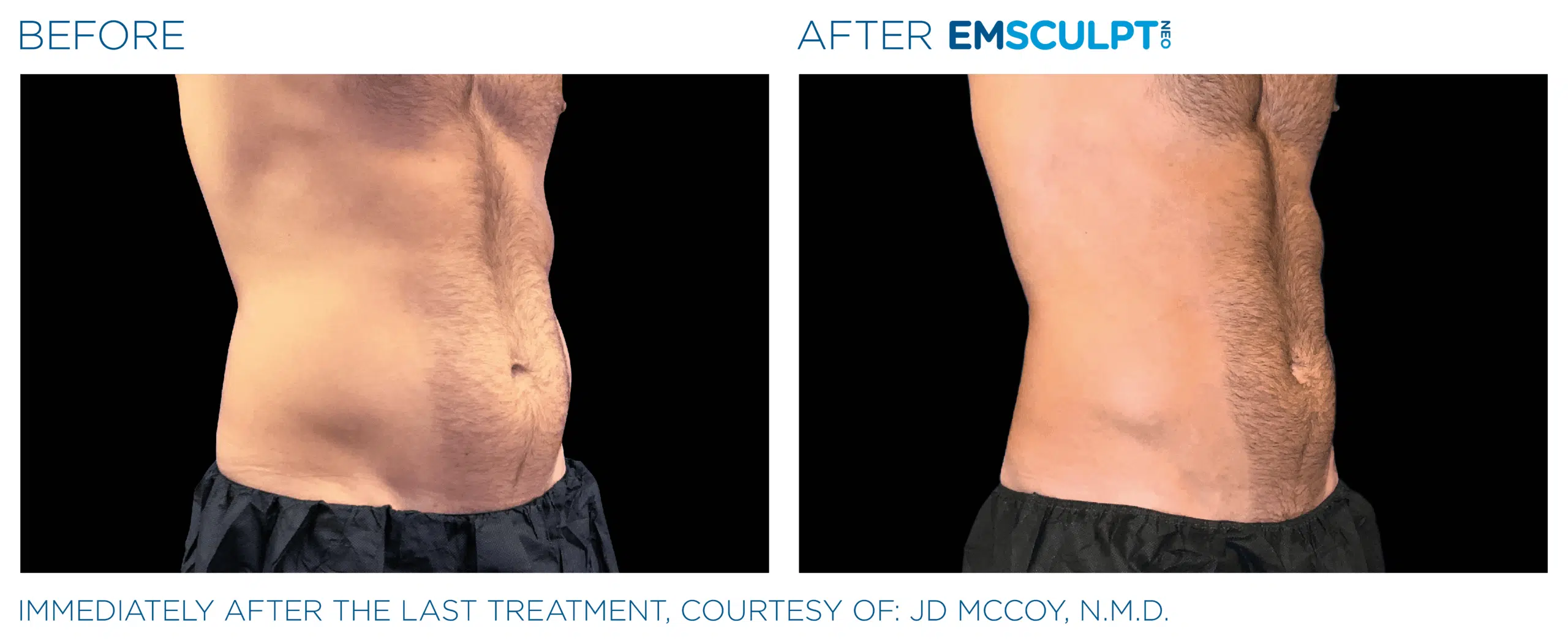 EMSCULPT NEO builds muscle, burns fat, and tightens skin