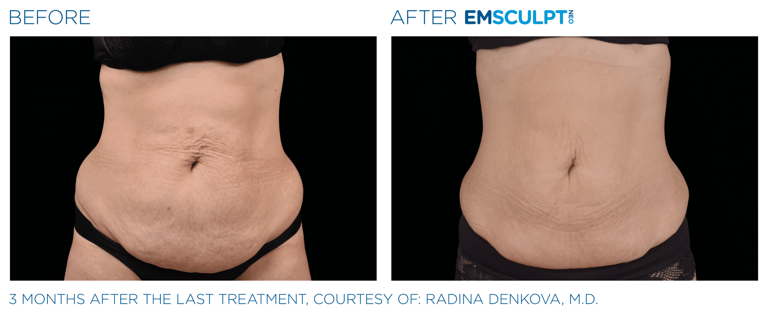 EMSCULPT NEO melt belly fat and tightens skin
