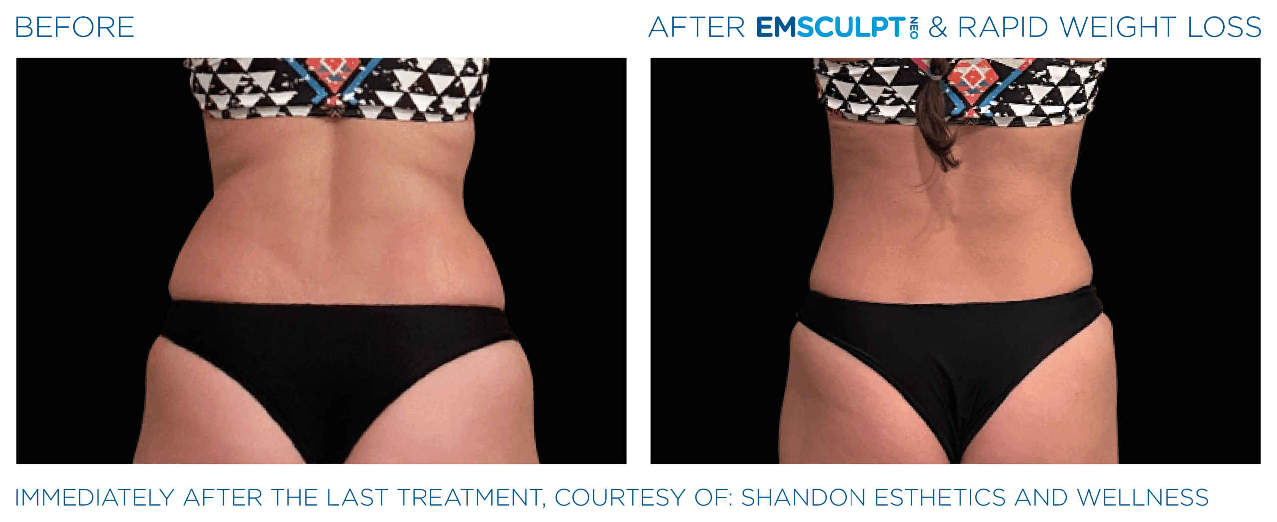 EMSCULPT NEO tones your waste line