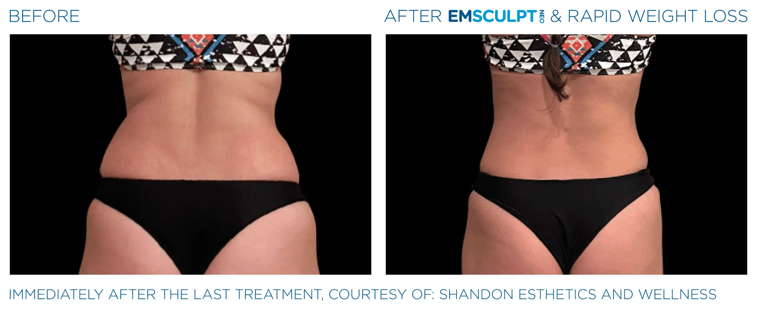 EMSCULPT NEO tones your waste line