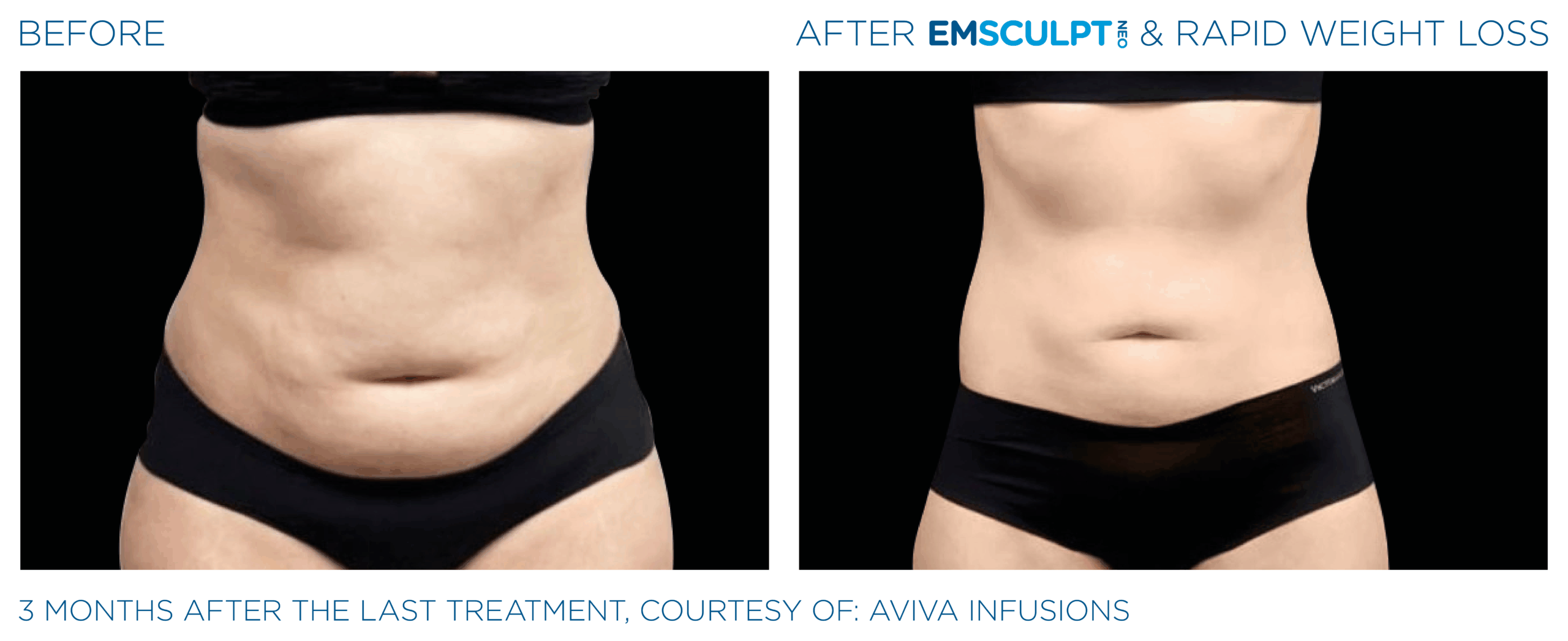 EMSCULPT NEO burns stubborn belly fat, and tightens skin