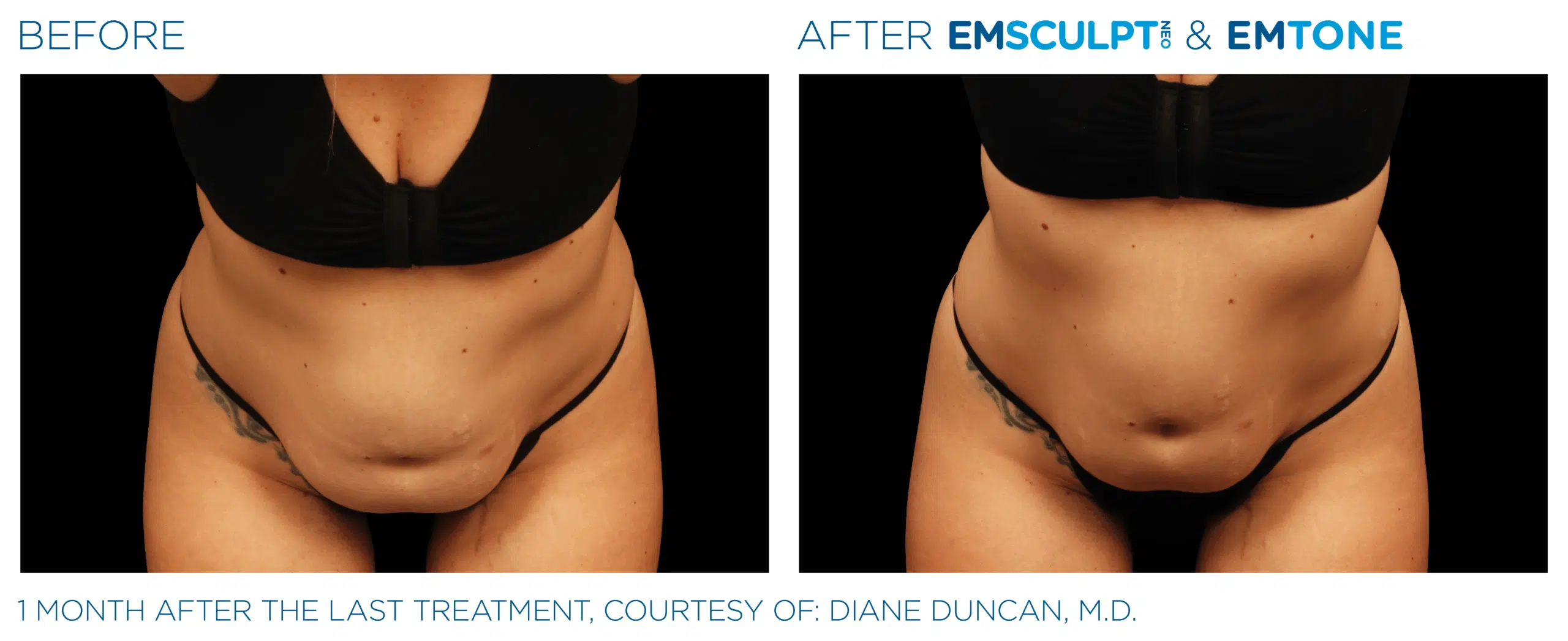 EMSCULPT NEO builds muscle, burns stubborn belly fat, and tightens skin