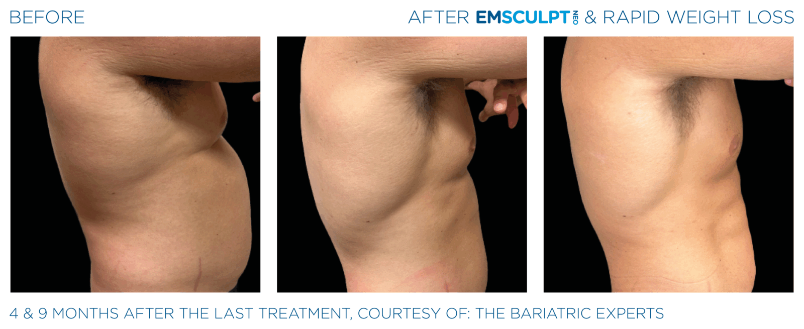 EMSCULPT NEO builds muscle, burns fat, and tones your body