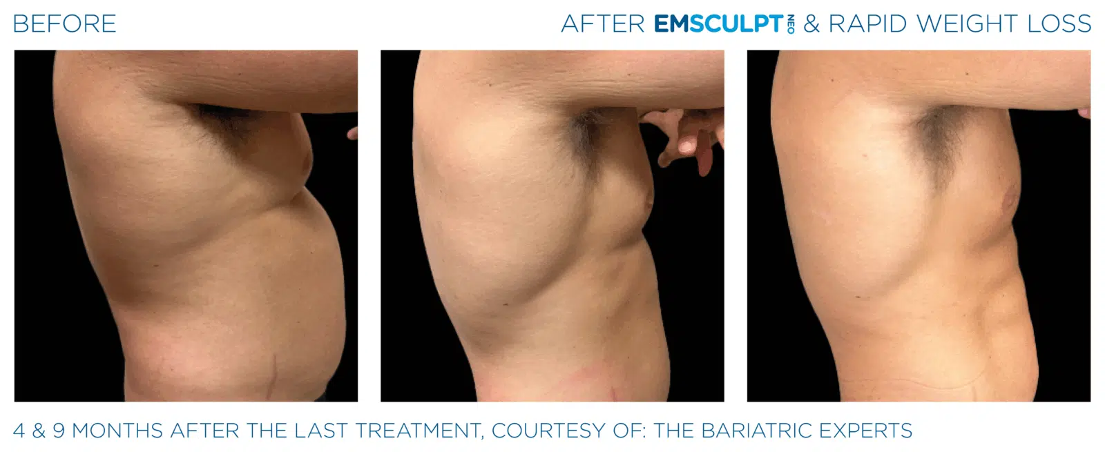 EMSCULPT NEO builds muscle, burns fat, and tones your body