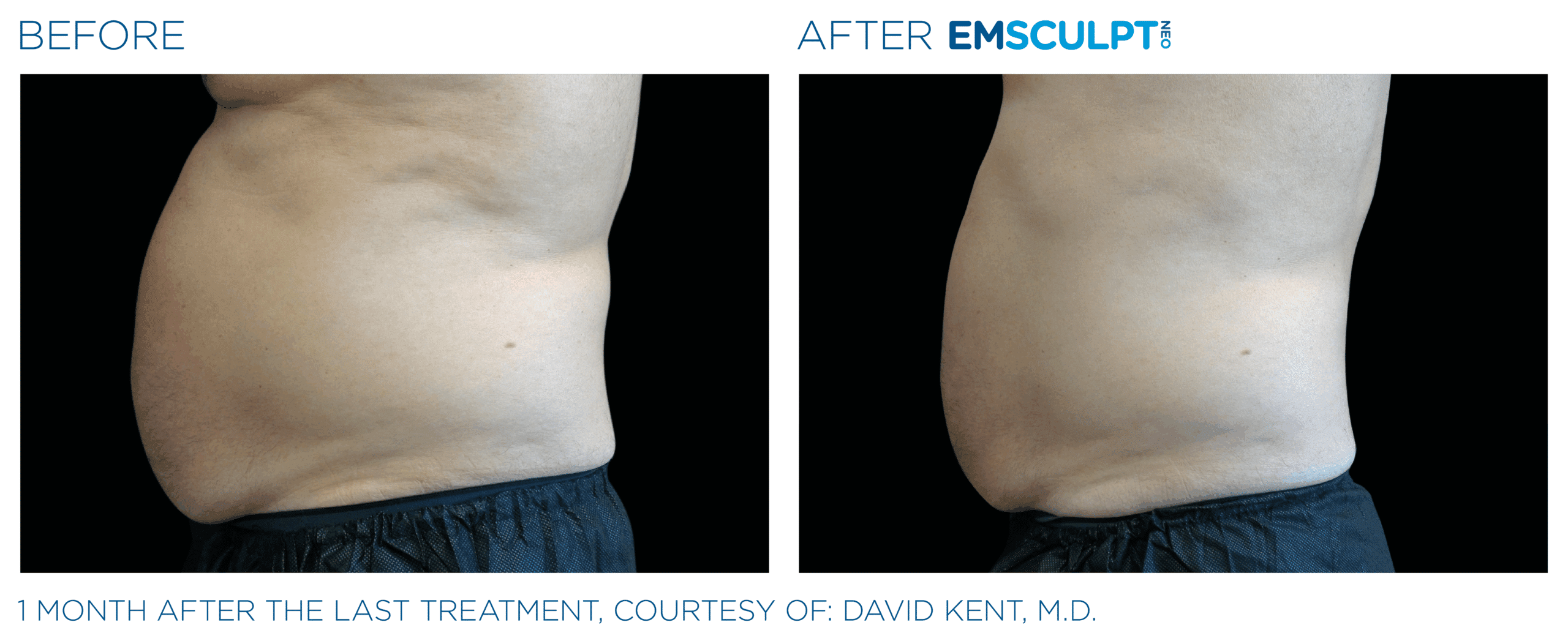 EMSCULPT NEO burns beer belly fat, and tightens skin