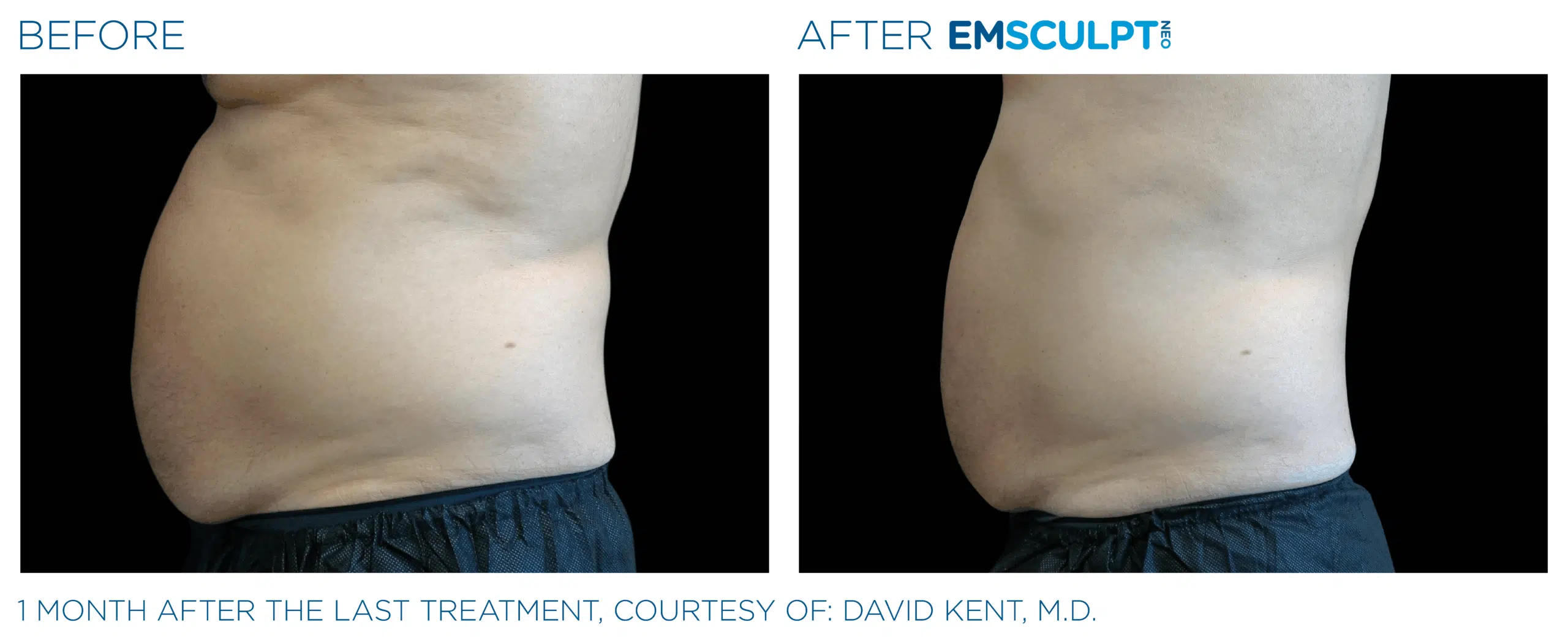 EMSCULPT NEO burns beer belly fat, and tightens skin