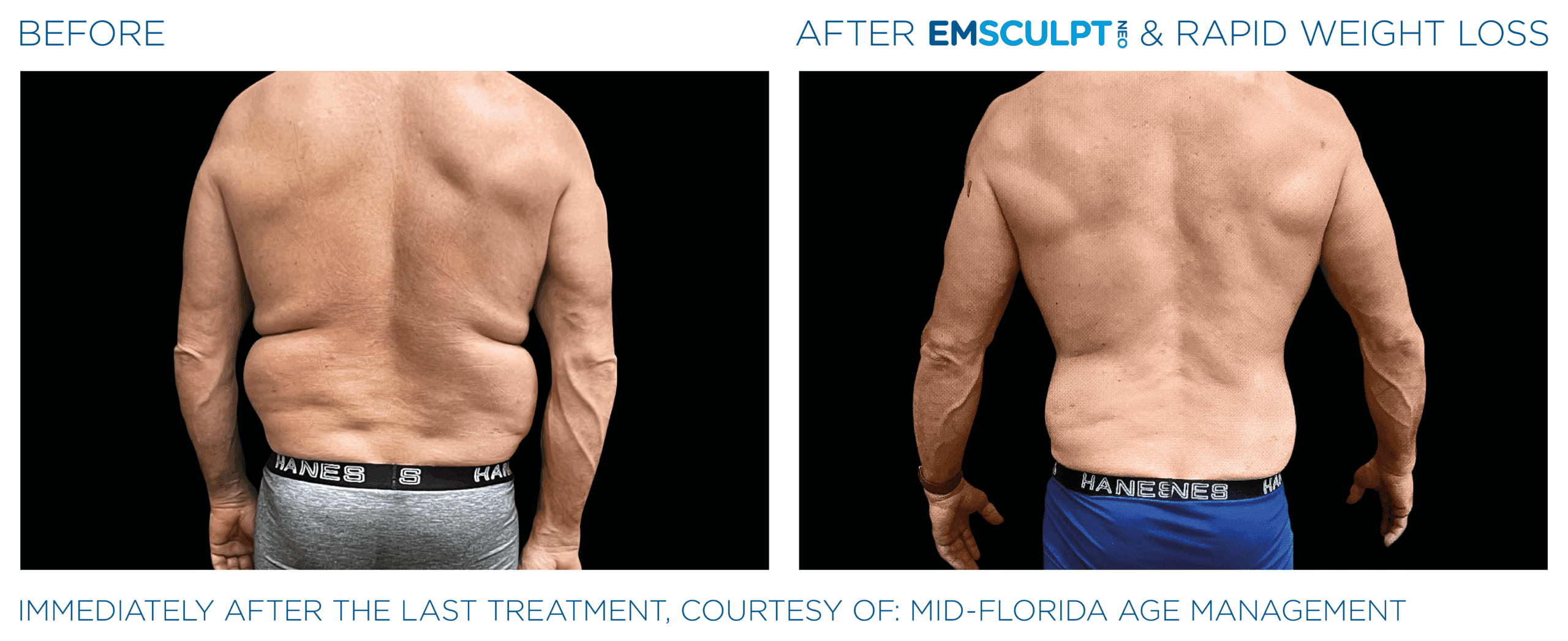 EMSCULPT NEO builds muscle, burns fat, and helps you lose weight
