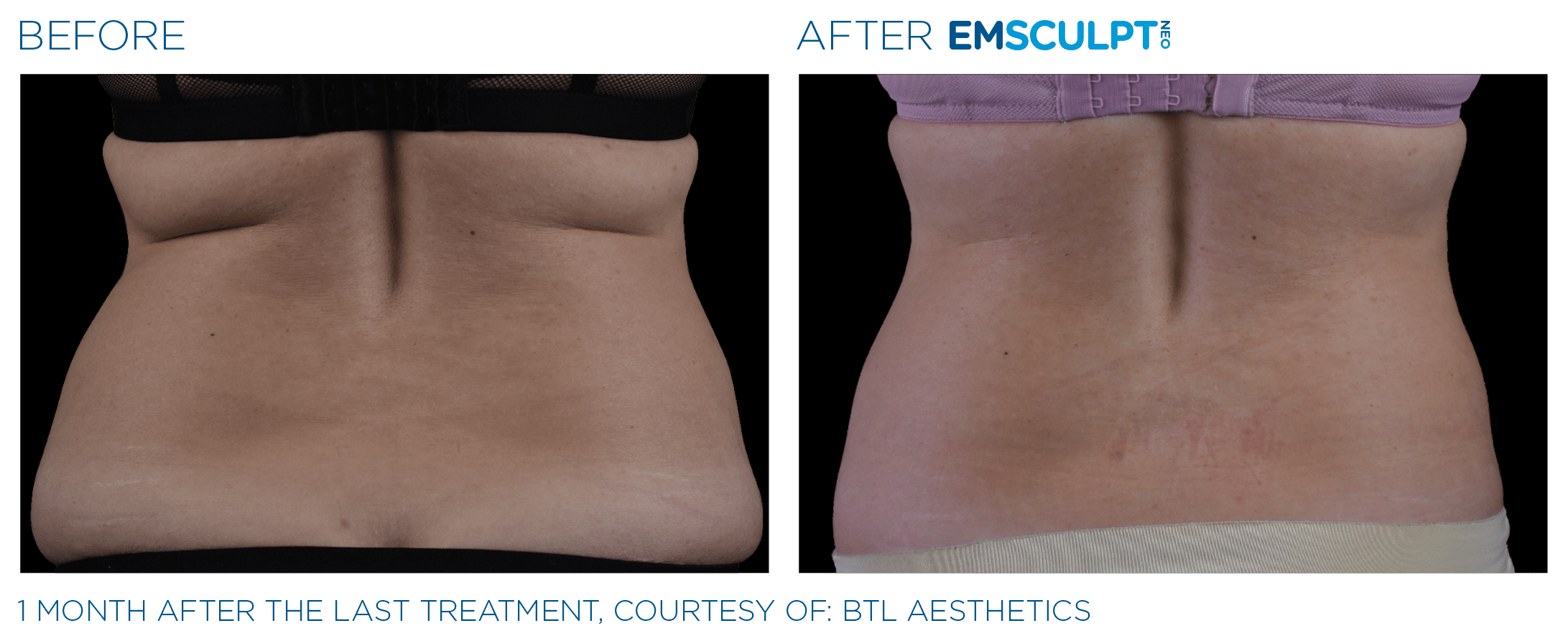 EMSCULPT NEO burns fat, builds muscle & tightens skin
