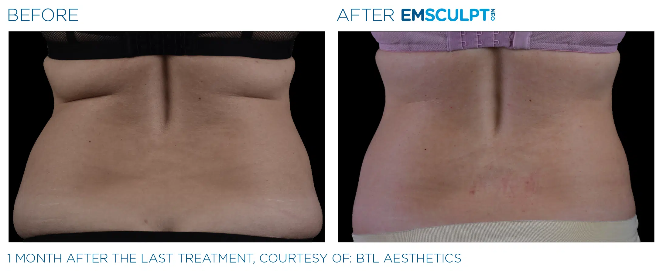 EMSCULPT NEO burns fat, builds muscle & tightens skin