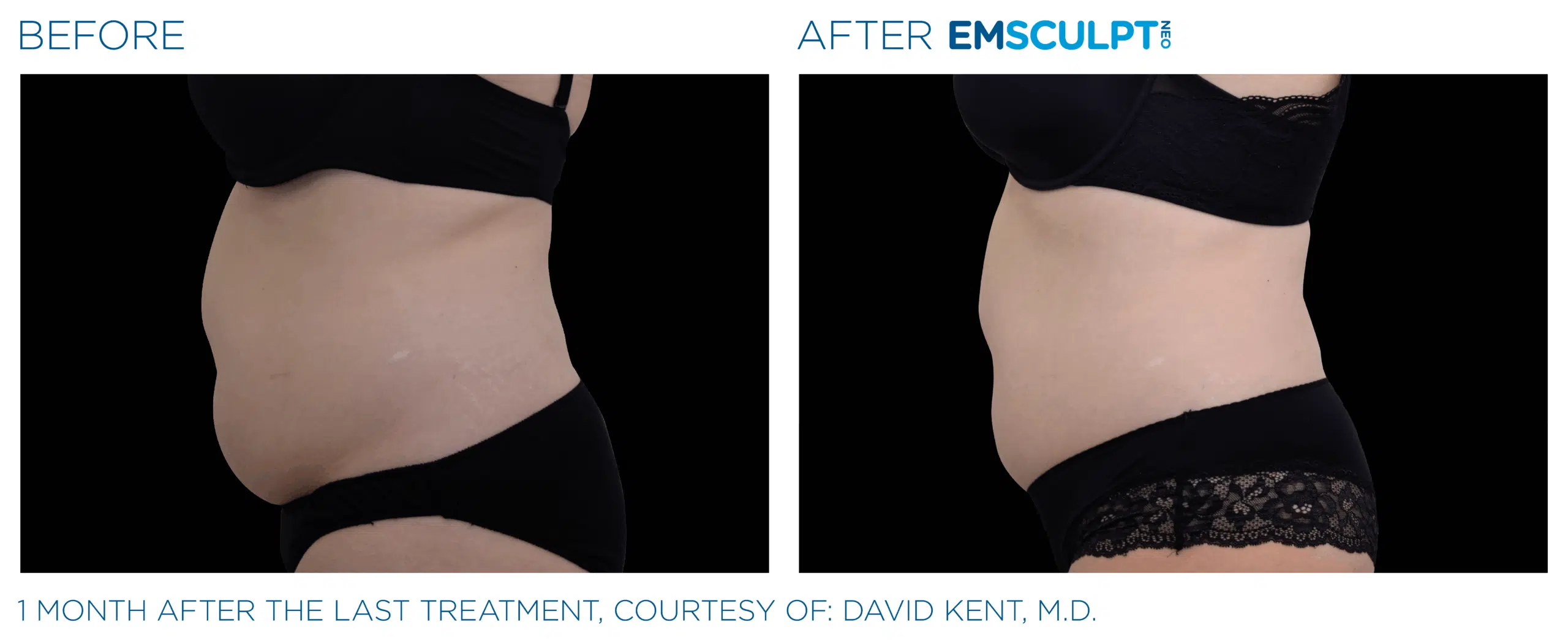 EMSCULPT NEO burn belly fat