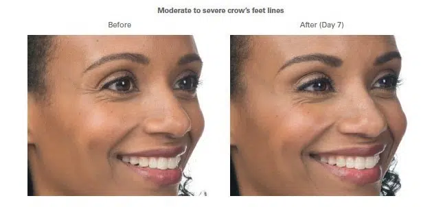 Botox for Crow's Feet