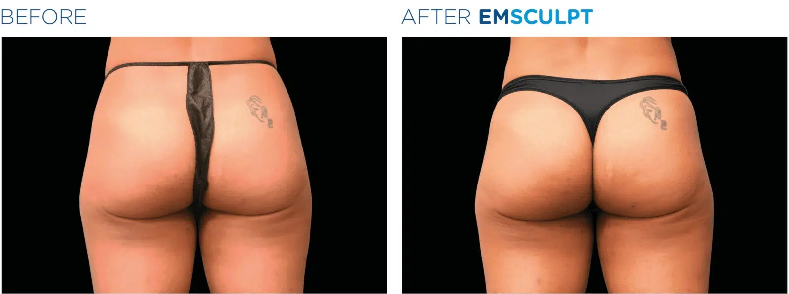 Before and After EMSculpt Butt Lift