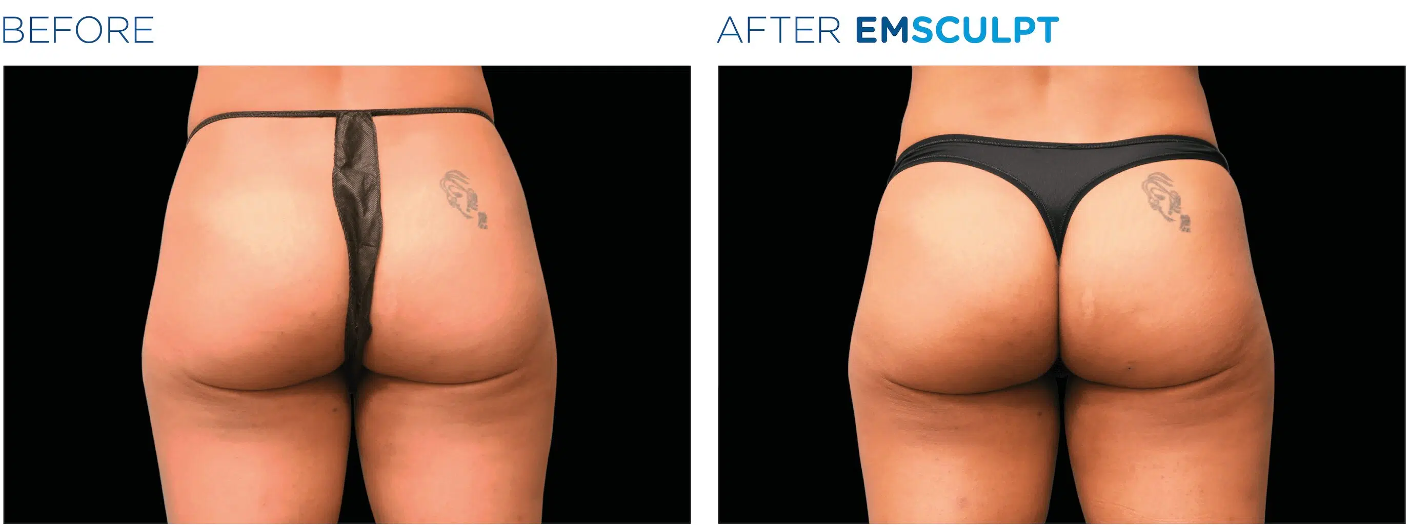 Sculptra Stoney Creek, Non-Surgical Butt Lift Near Me