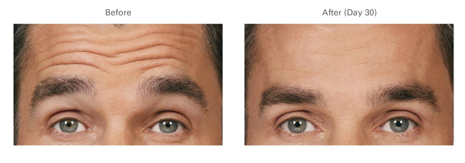 Botox for Forehead