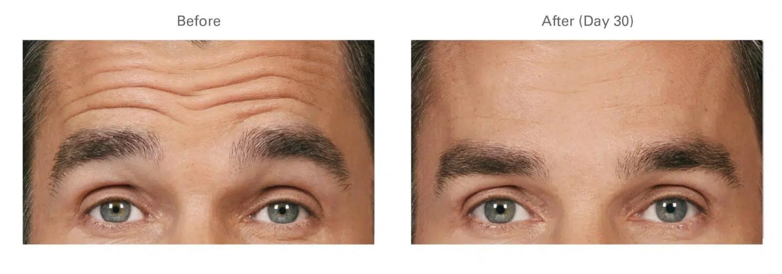 Botox for Forehead