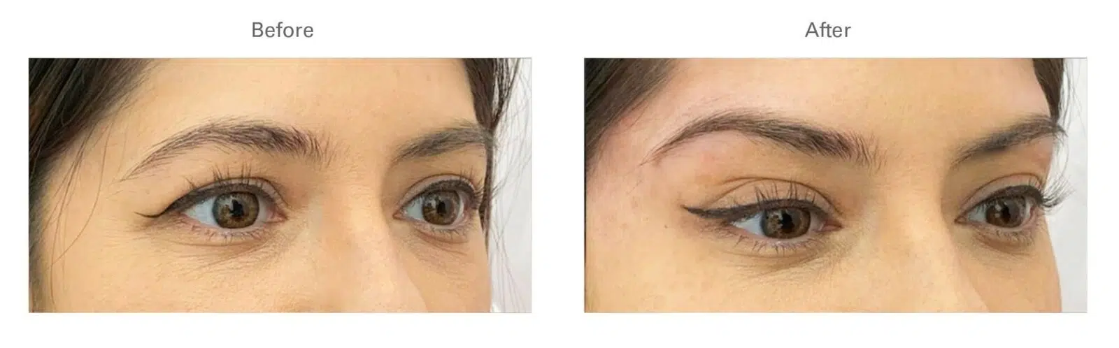 Botox for Brow Lift