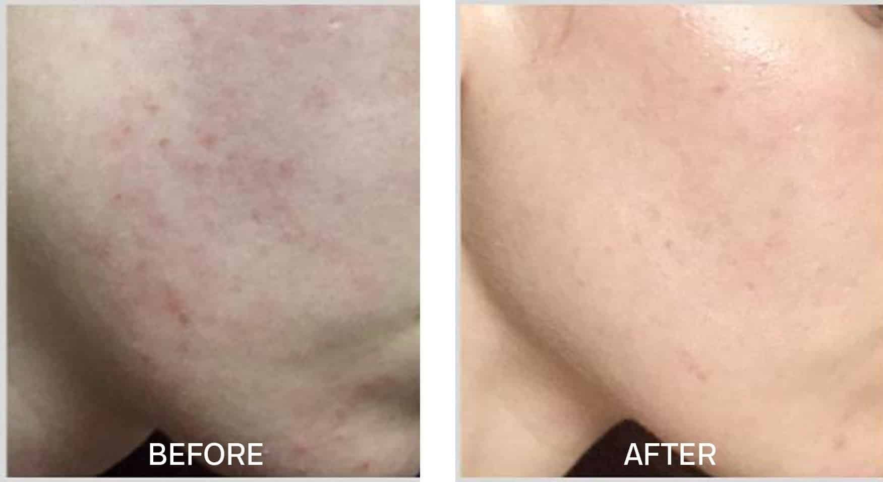 Cost of accutane in ontario
