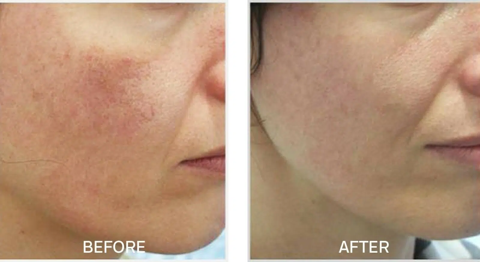Skincare for Rosacea