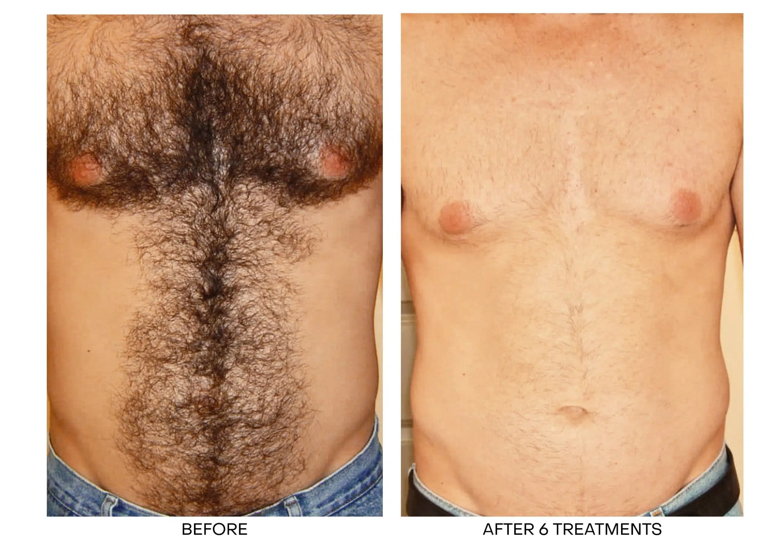 Laser hair removal shop toronto