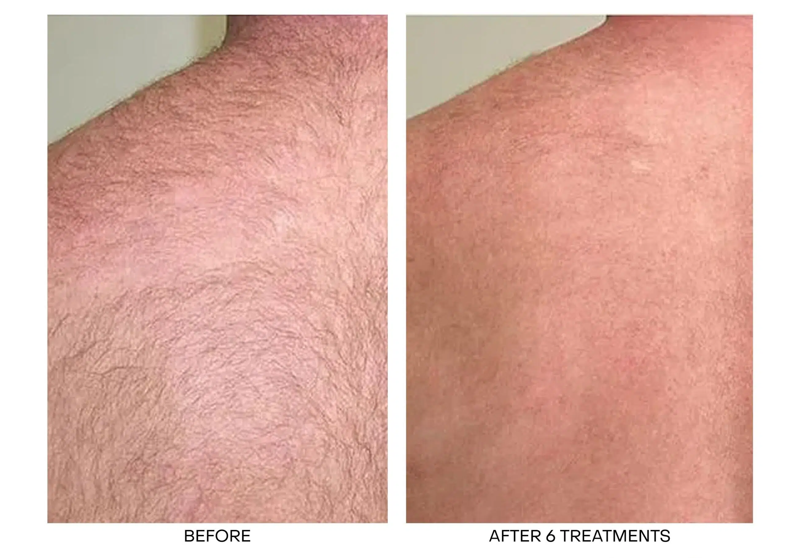 Best Laser Hair Removal Toronto Laser Hair Removal Near Me