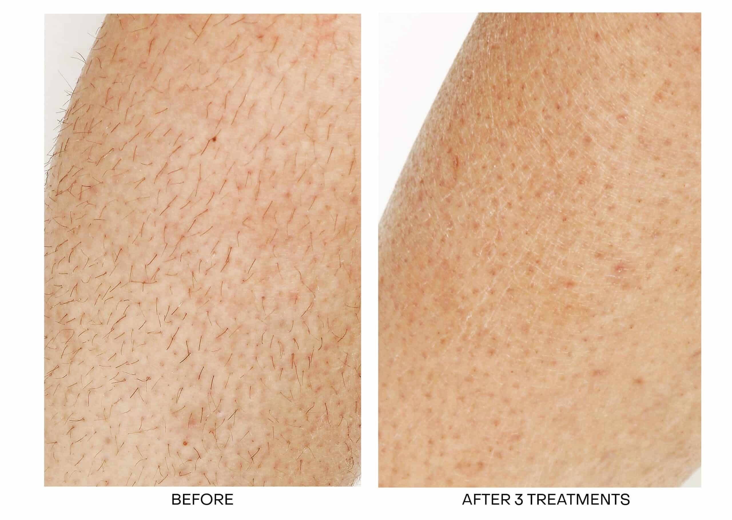 Best Laser Hair Removal Oakville | Oakville Laser Hair Removal Near Me Best Laser Hair Removal Oakville | Oakville Laser Hair Removal Near Me
