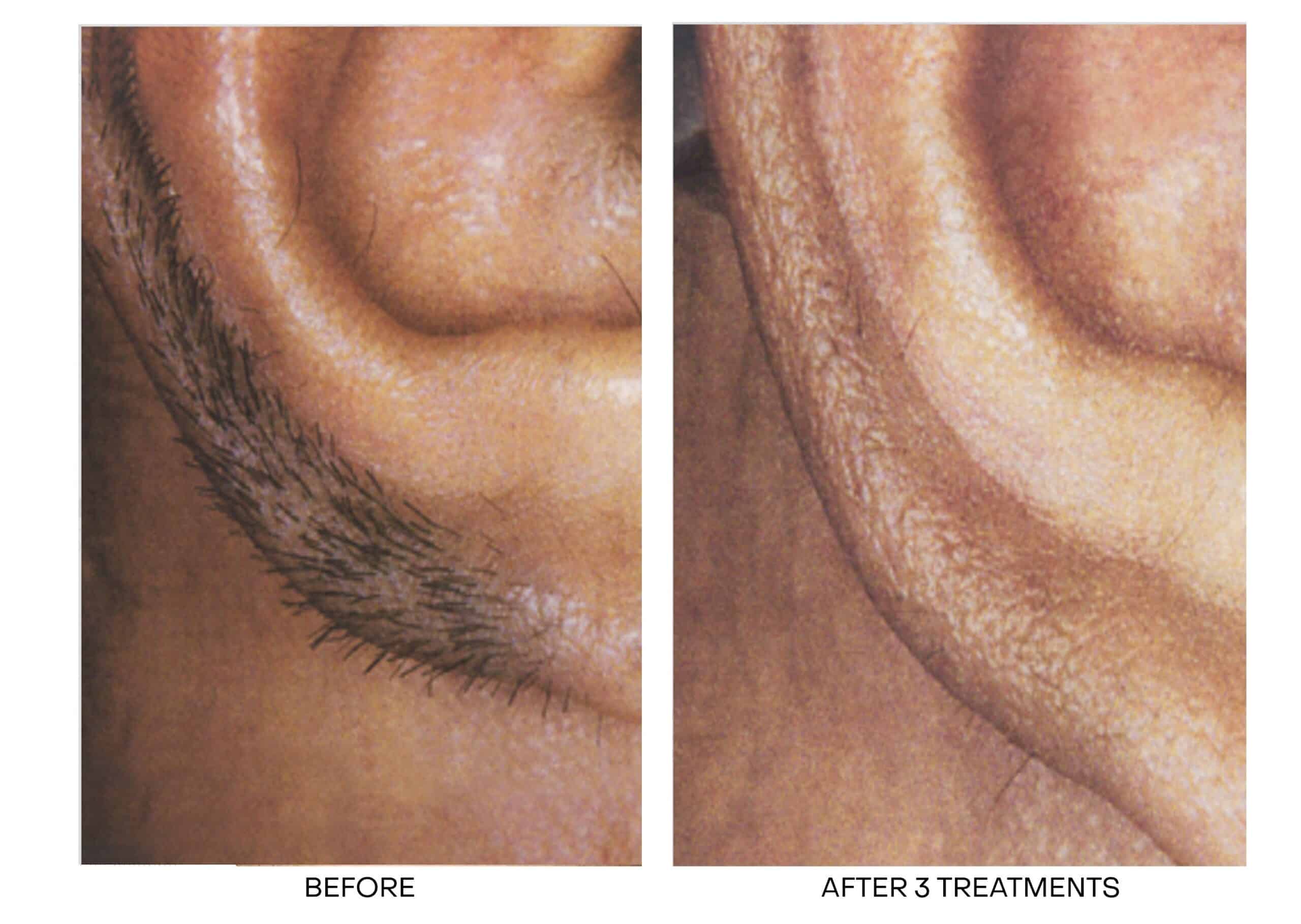 Best Laser Hair Removal Oakville | Oakville Laser Hair Removal Near Me Best Laser Hair Removal Oakville | Oakville Laser Hair Removal Near Me