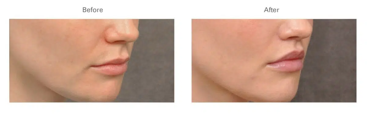 Botox Lip Flip