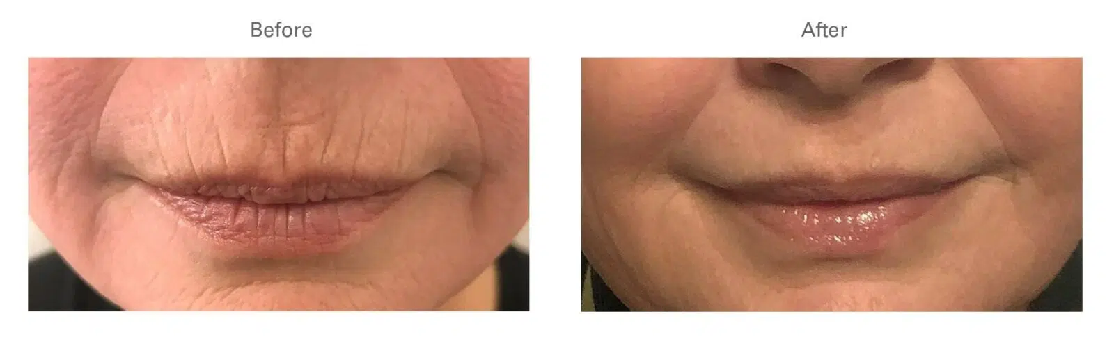 Botox for Lip Lines