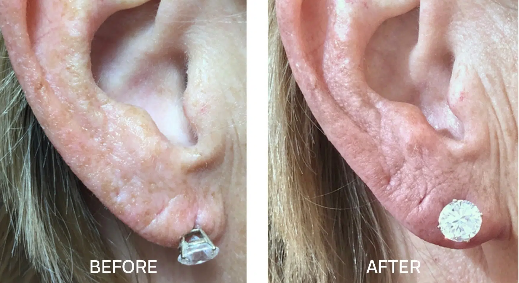 Earlobe Repair | Spartanburg | Greer ENT & Allergy