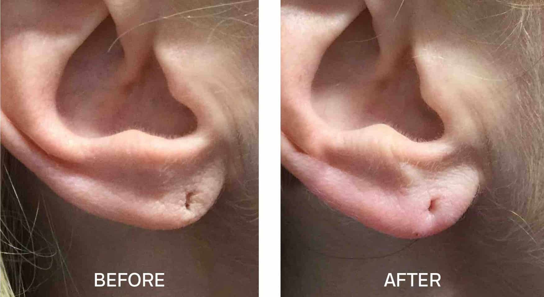 Earlobe Repair – Patient 221 | Jonathan Hall, MD, FACSJonathan Hall, MD,  FACS