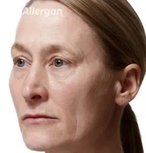 Juvederm Volite Price - After