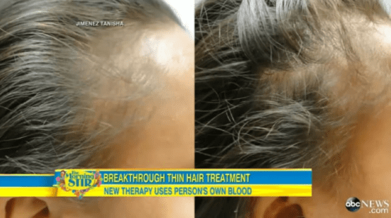 PRP Hair Treatment Toronto | PRP Hair Restoration Ontario PRP Hair Treatment Toronto | PRP Hair Restoration Ontario