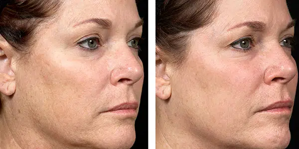 Fraxel laser treatment before and after