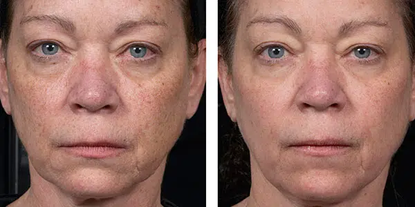 fraxel full face treatment