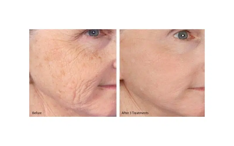 PRP® Facial for Skin Texture