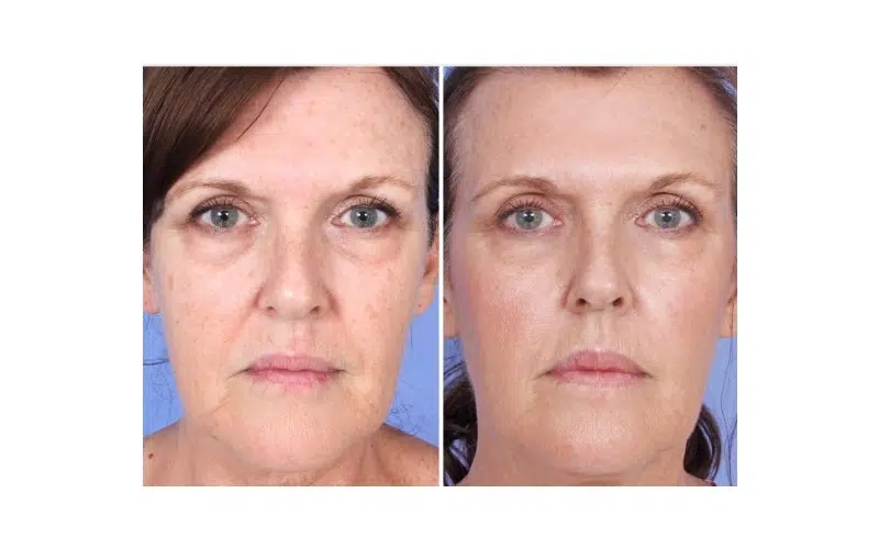 PRP® Facial for overall complexion