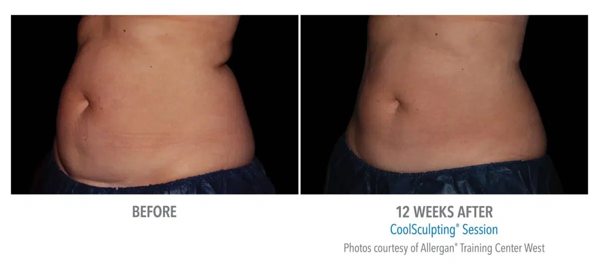 CoolSculpting Stomach Before and After