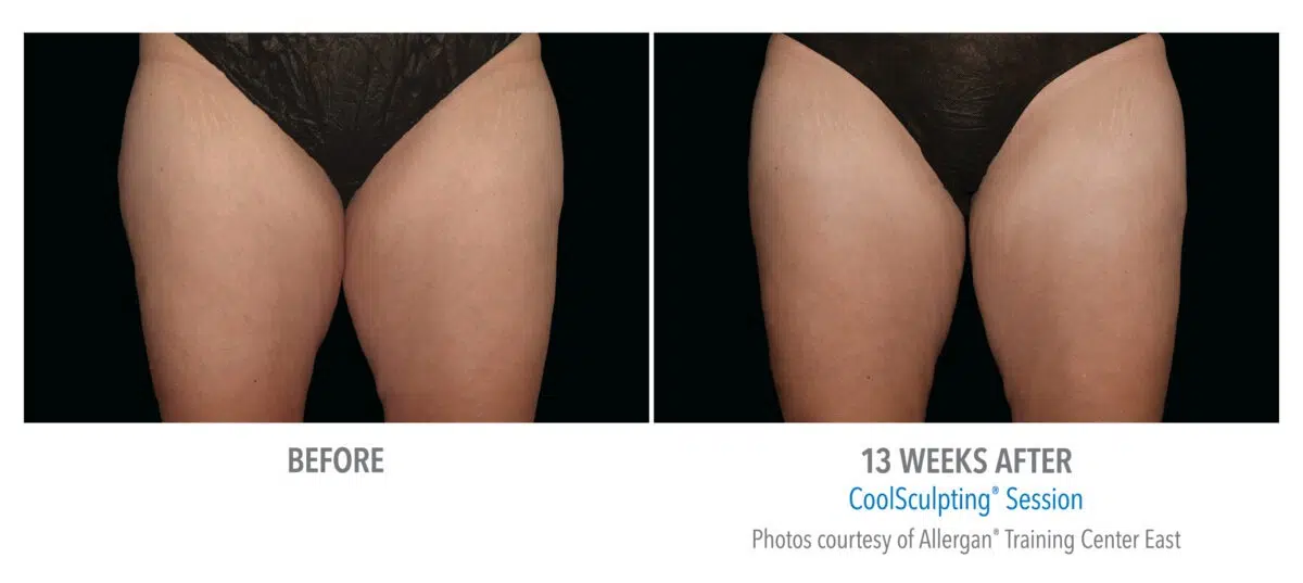 CoolSculpting Inner Thigh Before and After