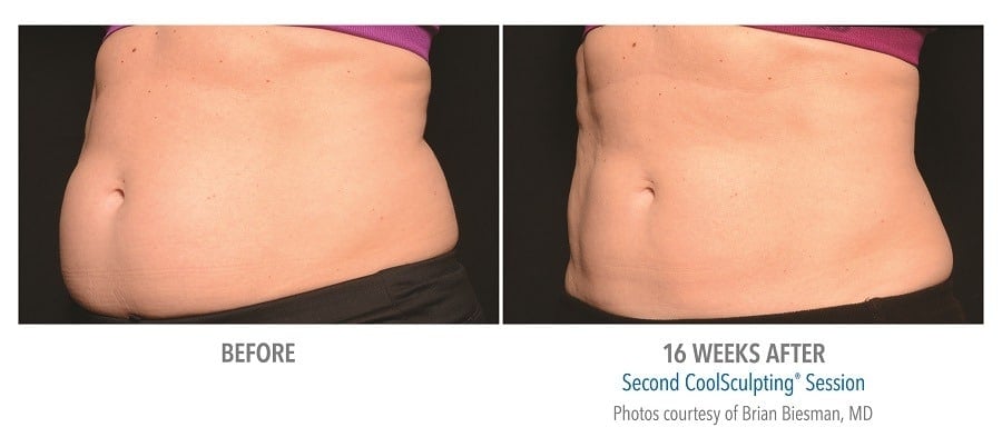 CoolSculpting Stomach Before and After