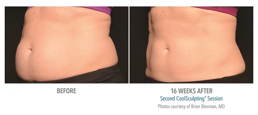 CoolSculpting Stomach Before and After