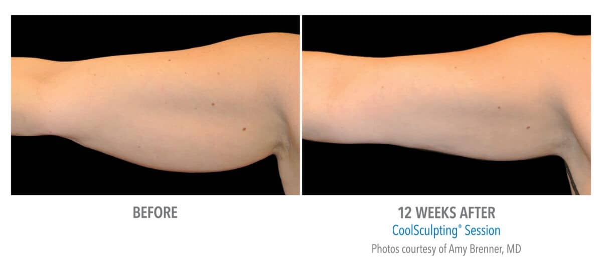 CoolSculpting Arms Before and After