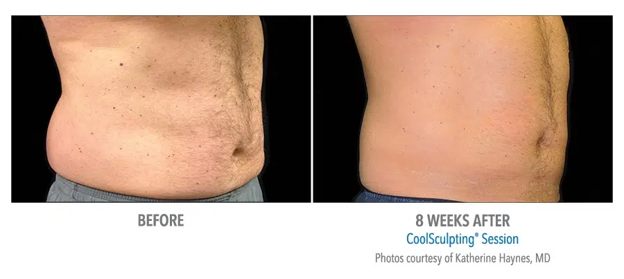 Coolsculpting love handles cost hotsell