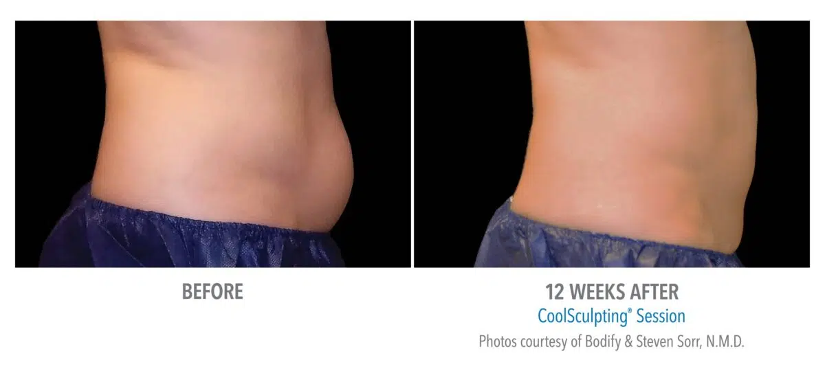 CoolSculpting to Lose Belly Fat